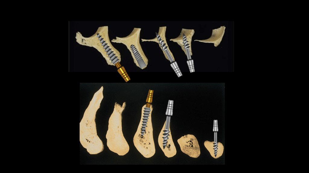 Bone configuration