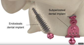 Types of implants