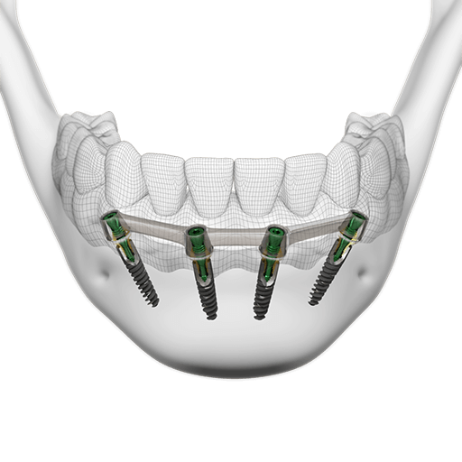 screw-retained