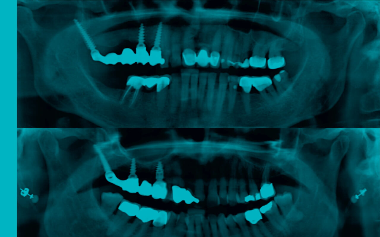 Implant successfully in the atrophied bone