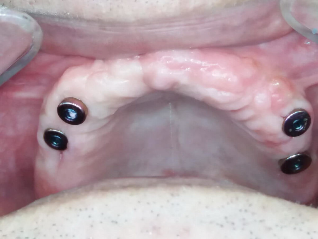 Barretained implant overdenture for treating edentulous maxilla TRATE