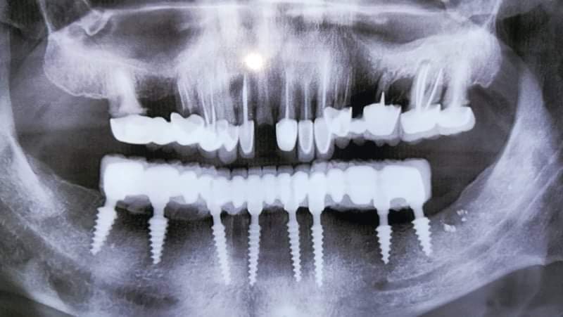 Minimal invasive in oral rehabilitation