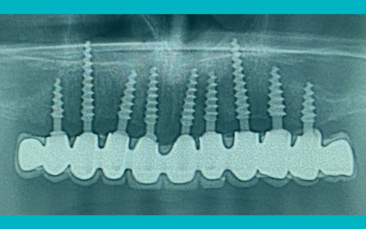 Infinite potential with immediate implantation. Secrets of successful cases.