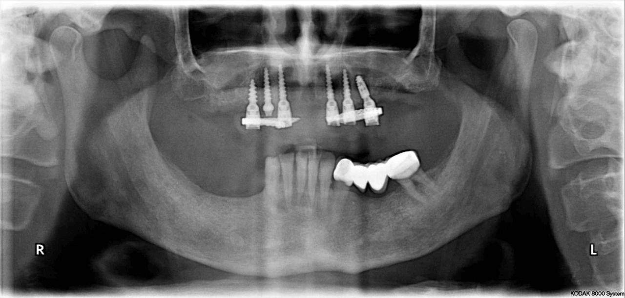 Teeth in a day