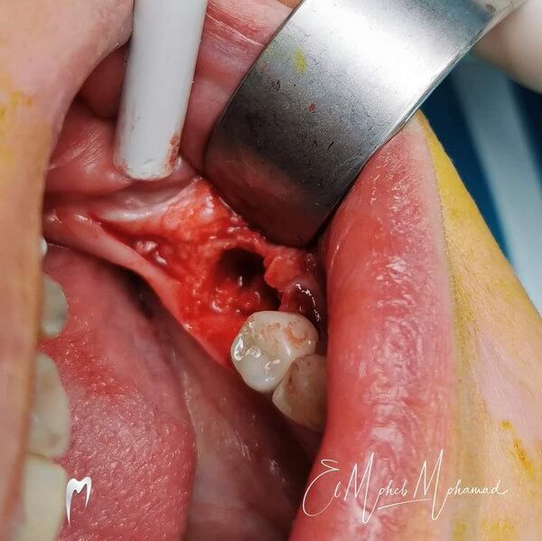 Post-extraction site after tooth removal