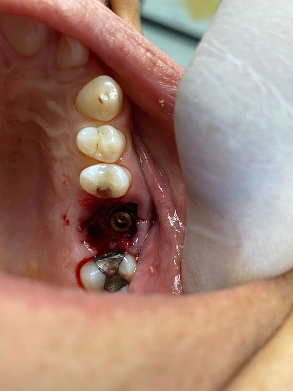 Implant inserted in post-extraction site