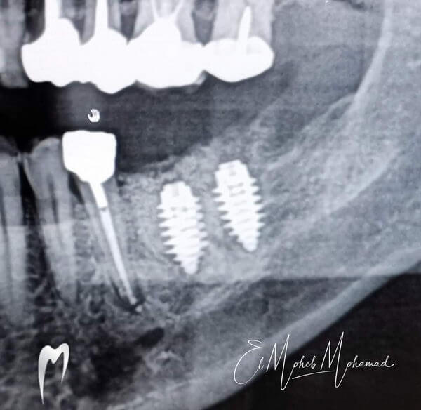 Final result x-ray